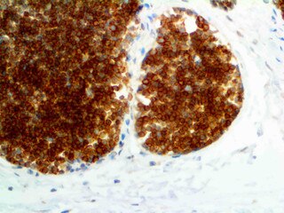 IHC of CD99 on an FFPE Ewing’s Sarcoma Tissue